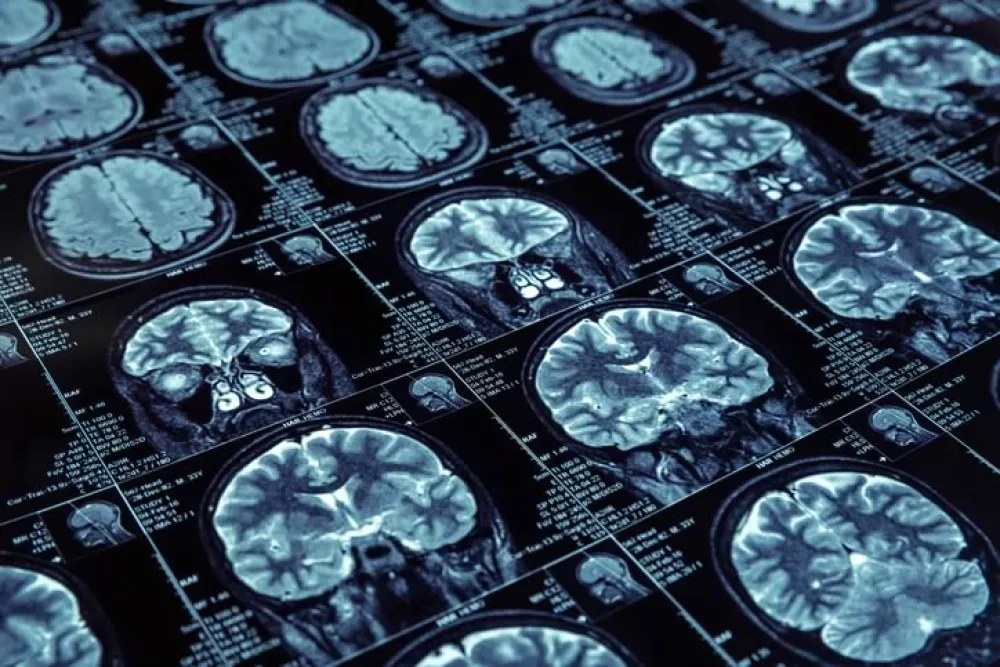 Varias radiografías del cerebro humano mostrando un posible deterioro
